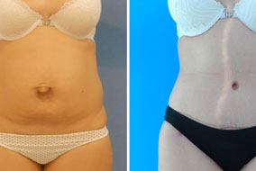 Abdominoplastia en Cancún Tummy Tuck